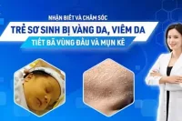 Nhận biết và chăm sóc trẻ sơ sinh bị vàng da, viêm da tiết bã vùng đầu và mụn kê